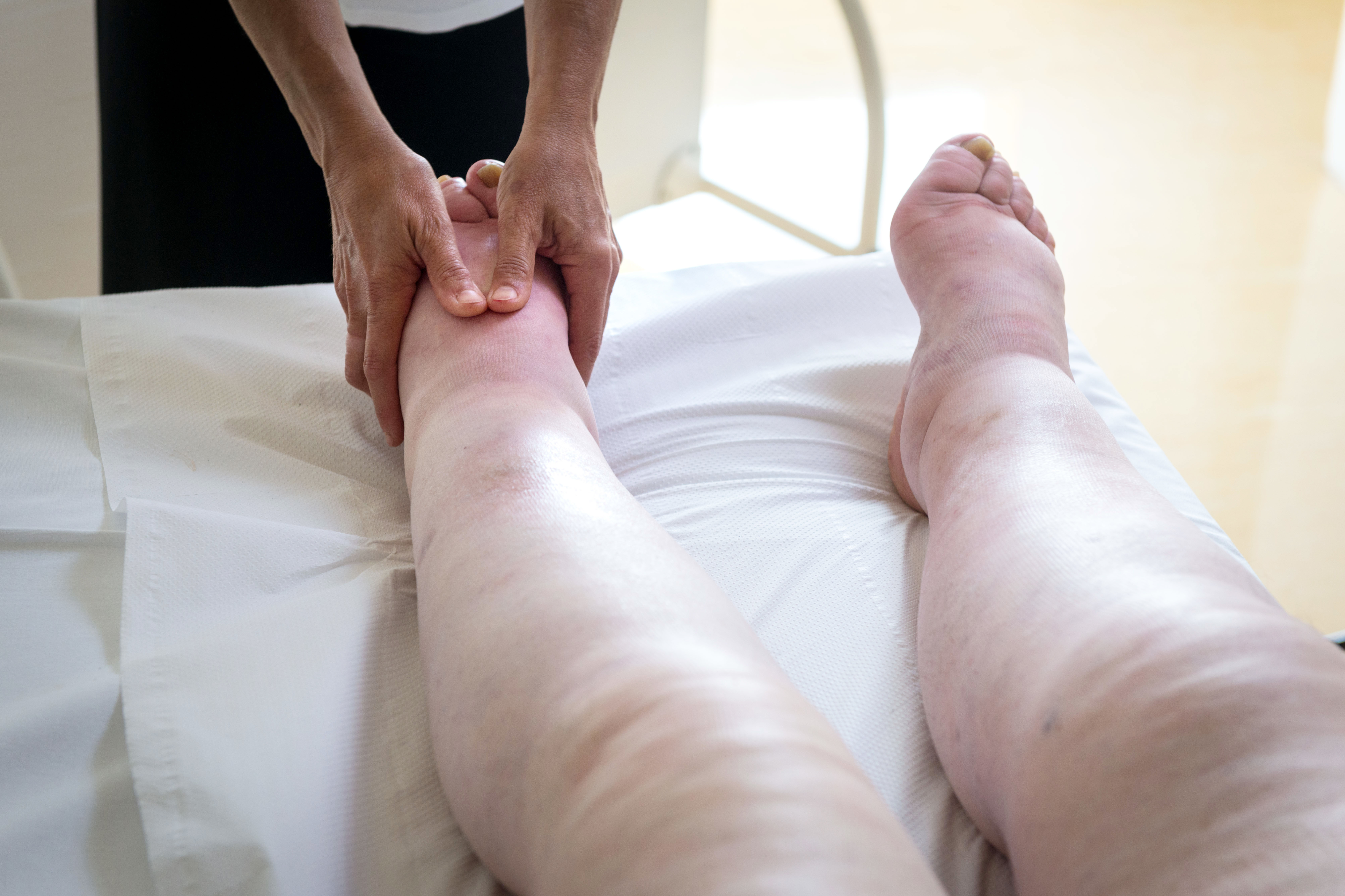 Terapista che esegue il massaggio linfodrenante  manuale su gambe con problemi di edema linfatico